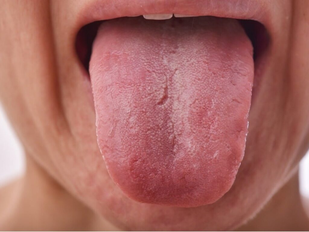 Your Tongue's Color Reveals Health Secrets: Discover What It Means