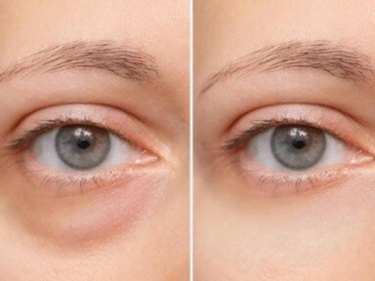 Wake Up Puffed? Don't Ignore These 5 Possible Causes!