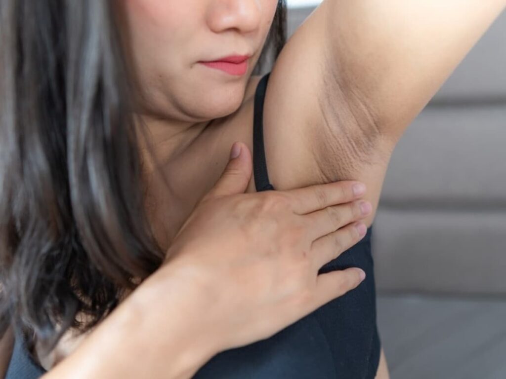 Dark Underarms: Not Just a Cosmetic Issue, But a Sign of These 5 Health Conditions